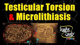 Testicular Early Subacute Torsion amp Diffuse Microlithiasis  Ultrasound  Case 323 [upl. by Yruoc97]