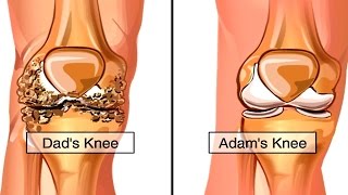 How Osteoarthritis Develops Animation  Causes amp Symptoms of Osteoarthritis  Knee Pain Video [upl. by Eintihw]