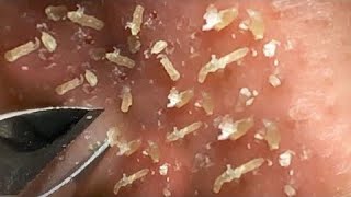 Best Satisfying Nose Plucking Blackheads Whiteheads Removal  Acne Treatment 22 [upl. by Renfred]