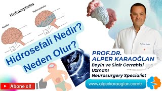 HİDROSEFALİ Hastalığı Nedir Neden Olur  ProfDr Alper KARAOĞLAN [upl. by Cheston]