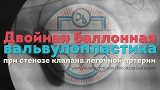 Двойная баллонная вальвулопластика Double Balloon Valvuloplasty in dog [upl. by Huntley]