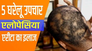 5 Home Remedies for Alopecia Areata Treatment of Alopecia Areata [upl. by Gaskill]