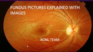 Fundus images explained by an ophthalmologist [upl. by Neerhtak]