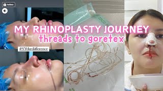 I DID IT Hiko Threads to Goretex Rhinoplasty  Doctor Price Experience  Karenn C [upl. by Seiter]