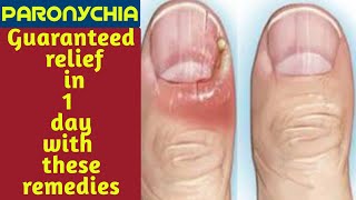 Paronychia finger home remedies  Paronychia fungal nail infection  Paronychia nail home remedies [upl. by Williamson]