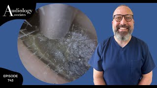 HARD AS STONE EAR WAX PLUG REMOVAL  EP743 [upl. by Burr211]