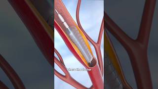 What is the Angioplasty Procedure [upl. by Anez904]