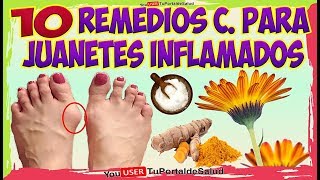 COMO ELIMINAR LOS JUANETES con Estos 10 Remedios Caseros Para los JUANETES INFLAMADOS [upl. by Kcirdled314]