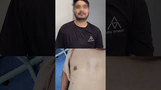 Gynecomastia In Lucknow  Gynecomastia Surgery Result Grade 2 Gynecomastia surgery lucknow [upl. by Mimi86]