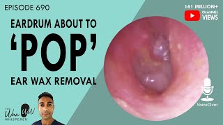 690  Eardrum about to POP Ear Wax Removal [upl. by Begga]