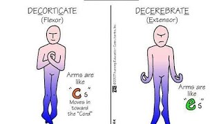 Differences between Decorticate Posturing and Decerebrate Posturing [upl. by Chance]