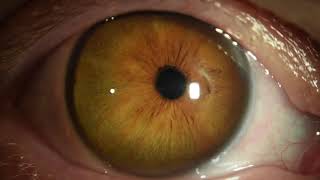 Xlinked megalocornea with dislocated IOL [upl. by Atsok]