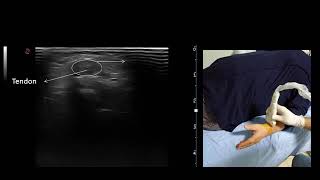 Ultrasound guided De Quervains Tenosynovitis injection [upl. by Behre466]