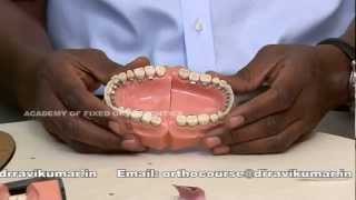 Lingual Orthodontics Course [upl. by Irrok]