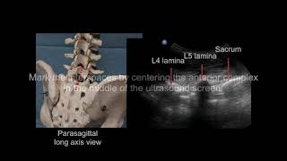 UltrasoundGuided Neuraxial Block AccessAnesthesiology McGrawHill Medical1 [upl. by Karon690]