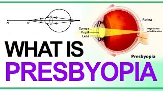 What is Presbyopia Class 10  Causes  Correction for Presbyopia  Defects of Vision Grade10 Physics [upl. by Harras]