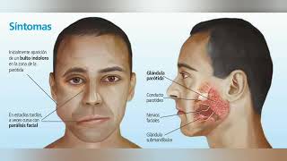 SIALOADENITIS INFECCIÓN DE LAS GLANDULAS SALIVALES BULTO EN REGION MAXILAR [upl. by Ayitahs]