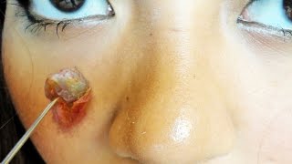 Best Pimple Pops Online Cyst Zits amp Blackheads Top Pops [upl. by Burrill]