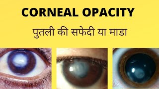 Corneal Opacity  Corneal Opacity Treatment  पुतली की सफेदी या माडा [upl. by Sonnie746]