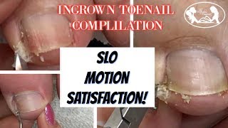 👣Satisfying Ingrown Toenail Compilation with Slo Motion 👣 [upl. by Ardnuhsed]